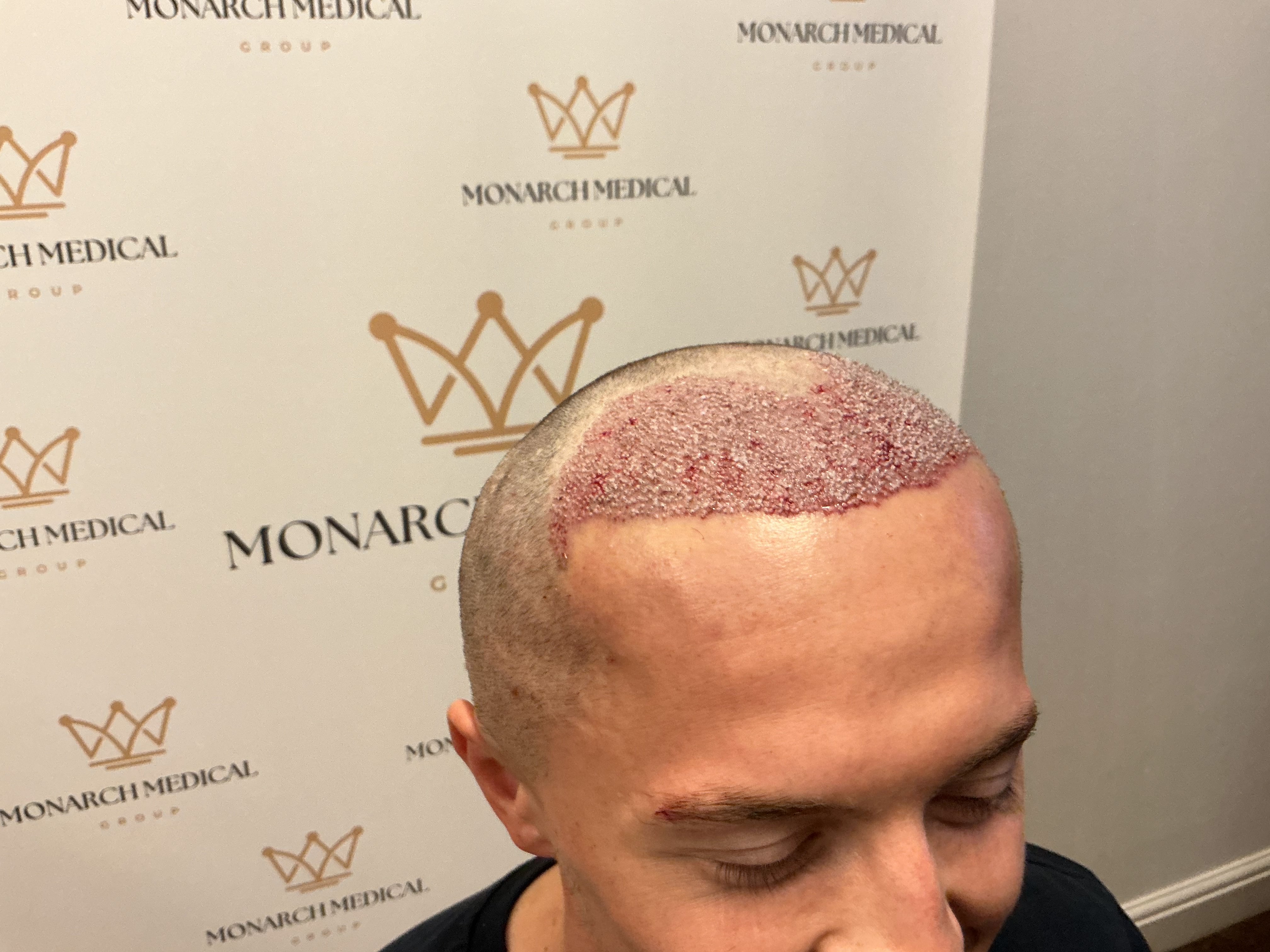 Advanced hairline recession — result photo 5